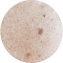 シミ・そばかす